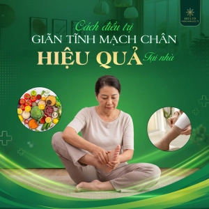 CÁCH ĐIỀU TRỊ GIÃN TĨNH MẠCH CHÂN HIỆU QUẢ TẠI NHÀ