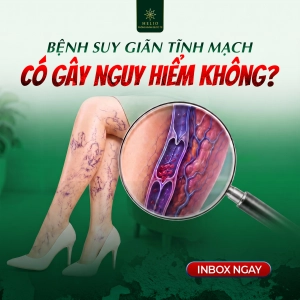 BỆNH SUY GIÃN TĨNH MẠCH CÓ GÂY NGUY HIỂM KHÔNG?