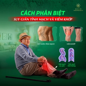 CÁCH PHÂN BIỆT SUY GIÃN TĨNH MẠCH VÀ VIÊM KHỚP