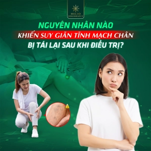NGUYÊN NHÂN NÀO KHIẾN SUY GIÃN TĨNH MẠCH CHÂN BỊ TÁI LẠI SAU KHI ĐIỀU TRỊ?