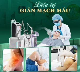 Điều trị giãn mạch máu
