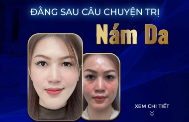ĐẰNG SAU CÂU CHUYỆN TRỊ NÁM DA THÀNH CÔNG CỦA CÔ NHÂN VIÊN VĂN PHÒNG SAU 1 LIỆU TRÌNH