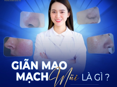 TẠI SAO CHỌN ĐIỀU TRỊ GIÃN MAO MẠCH TĨNH MẠCH Ở PHÒNG KHÁM QUỐC TẾ HELIO