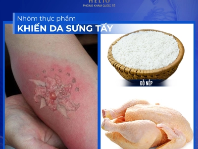 CẬN CẢNH QUÁ TRÌNH XÓA XĂM TẠI HELIO