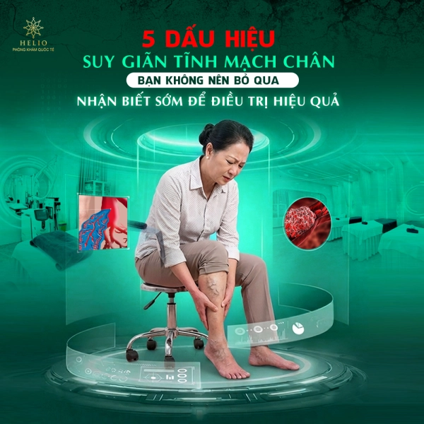 5 DẤU HIỆU SUY GIÃN TĨNH MẠCH CHÂN BẠN KHÔNG NÊN BỎ QUA | NHẬN BIẾT SỚM ĐỂ ĐIỀU TRỊ HIỆU QUẢ